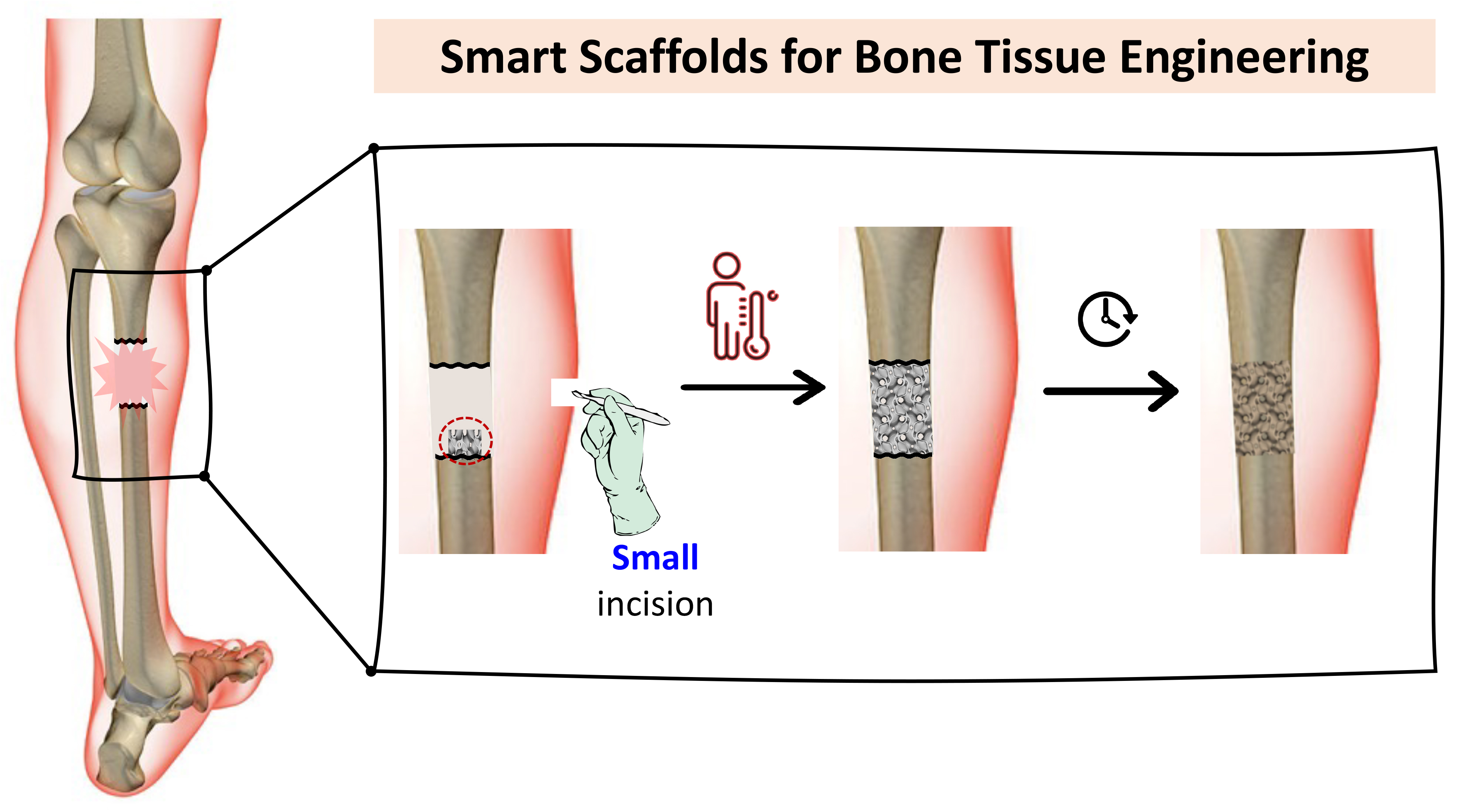 Bone replacement
